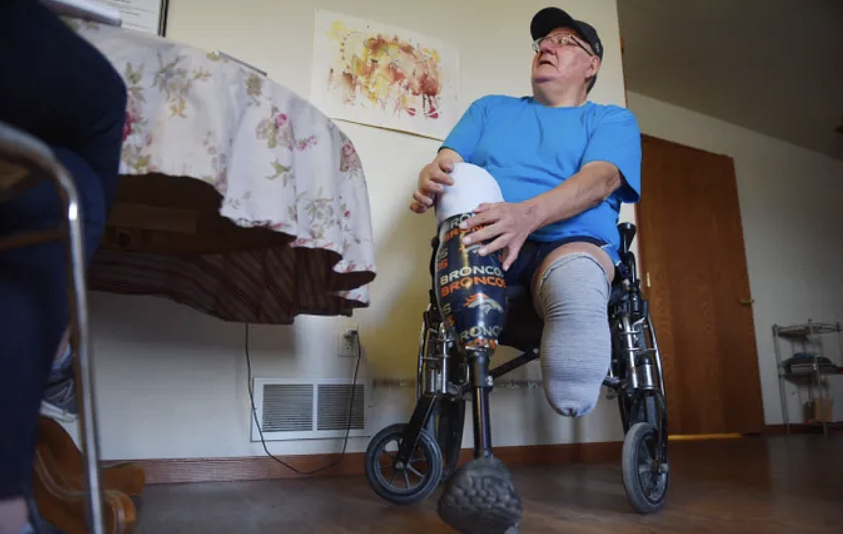 Lino Spotted Elk showed a torn prosthetic sleeve Tuesday, Sept. 18, at his home in Rosebud. Lino Spotted Elk showed a torn prosthetic sleeve Tuesday, Sept. 18, at his home in Rosebud.
