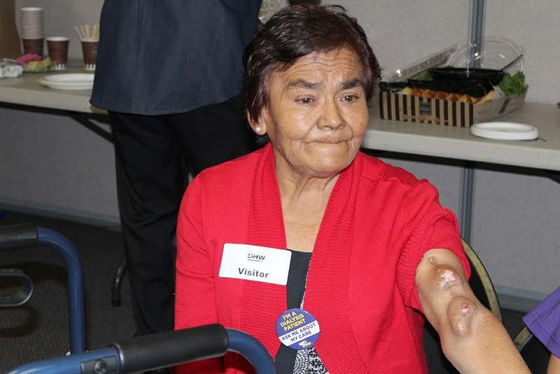 Susana Castro’s arms show the damages caused by her dependence on dialysis after her diabetes led to kidney failure. (Francisco Castro)