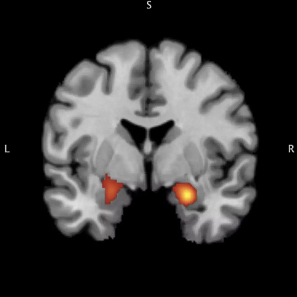 Youth with a history of trauma exhibit a hyperactive amygdala response to negative emotional cues. (This image originally appeared in Tyler C. Hein and Christopher S. Monk's "Research Review: Neural Response to Threat in Children, Adolescents, and Adults After Child Maltreatment" in the Journal of Child Psychology and Psychiatry, Vol. 58, Issue 3.)